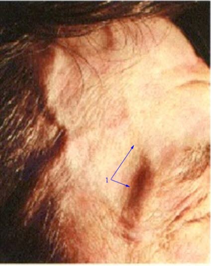 Arteritis temporalis