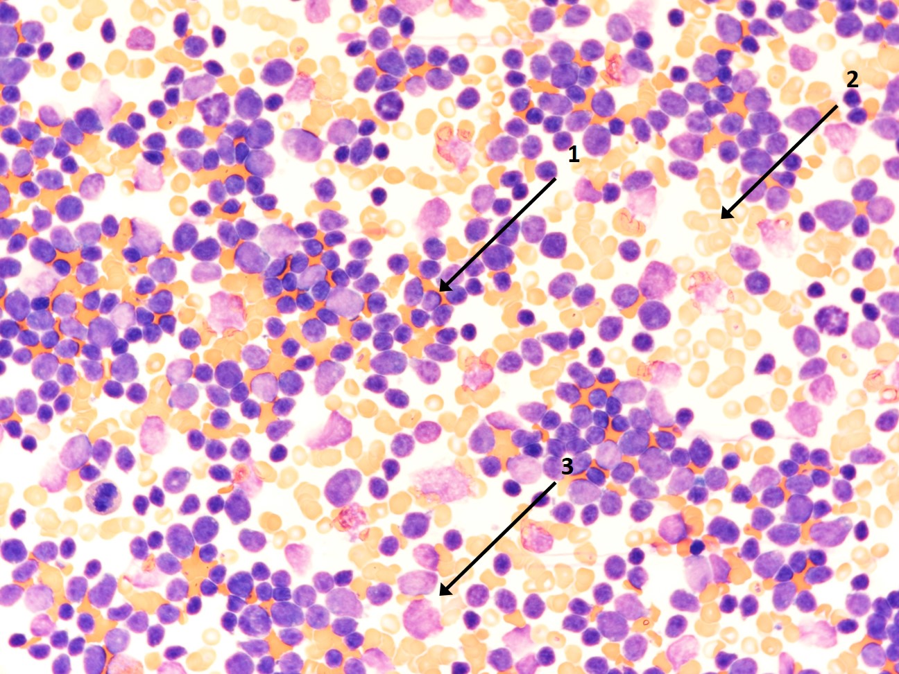 Knochenmarkausstrich mit vielen lymphatischen Blasten (1), Erythrozyten (2) und einigen Zelltrümmern (3)