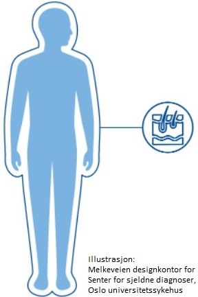 Epidermolysis bullosa (EB)