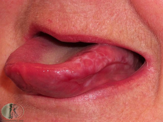 4151-2-oral-lichen-planus-1.jpg