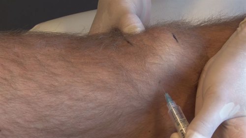 Insticksställe vid intraartikulär injektion av knäled