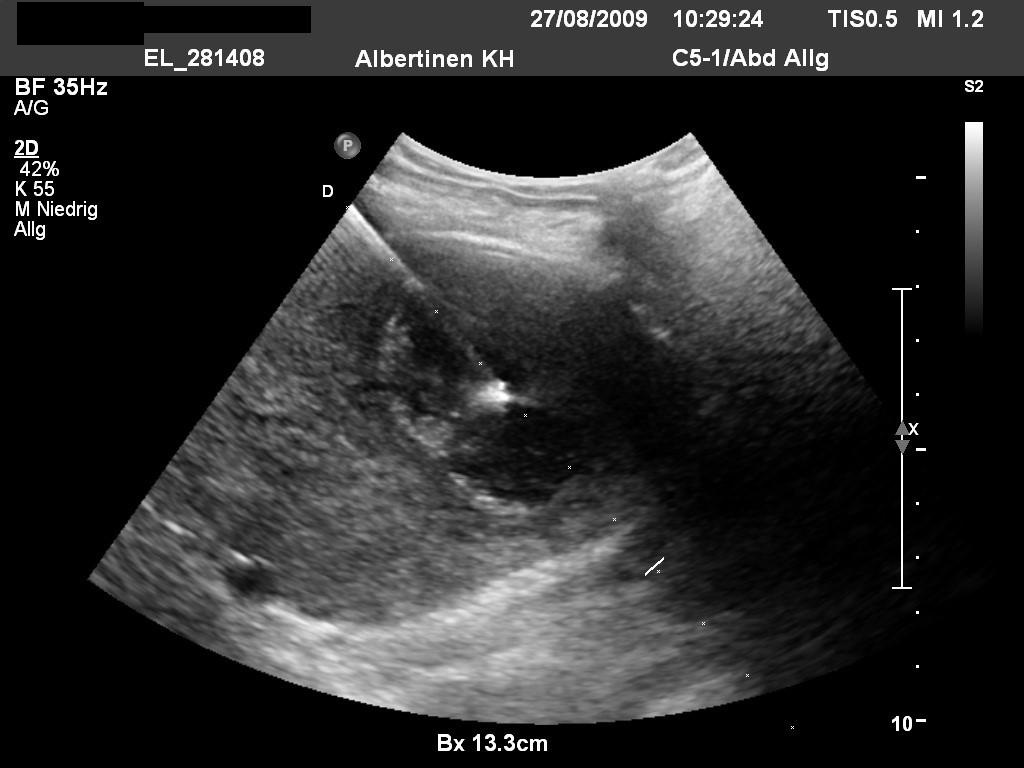 Sonografie: Leberabszess mit Anlage einer Abszessdrainage (mit freundlicher Genehmigung von sonographiebilder.de ©Albertinen-Diakoniewerk e. V., Hamburg)