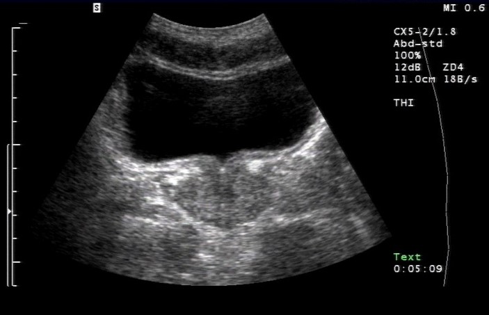 Sonografie: Prostata, Normalbefund (mit freundlicher Genehmigung von sonographiebilder.de ©Albertinen-Diakoniewerk e. V., Hamburg).