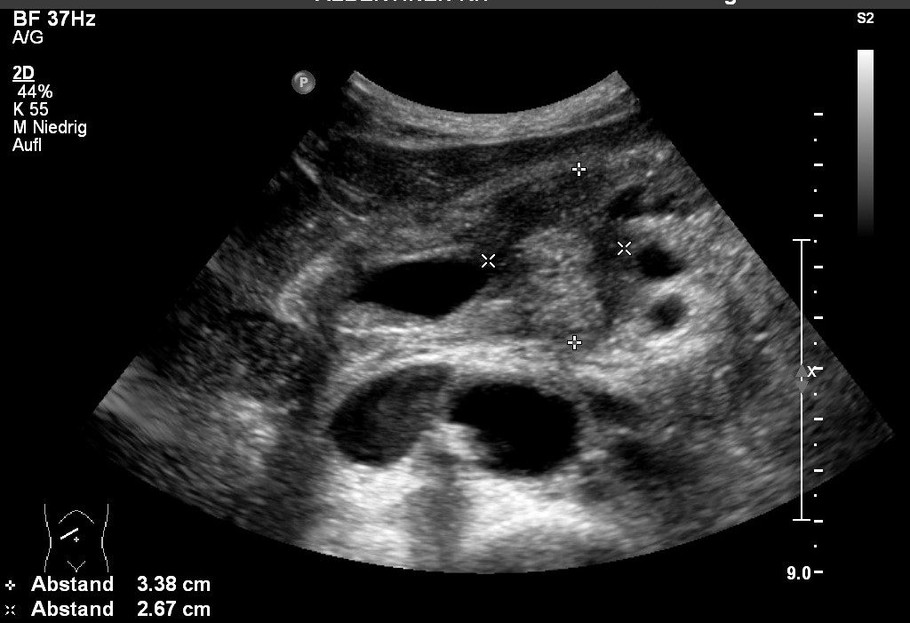 Sonografie: Pankreaskopfkarzinom (mit freundlicher Genehmigung von sonographiebilder.de ©Albertinen-Diakoniewerk e. V., Hamburg)