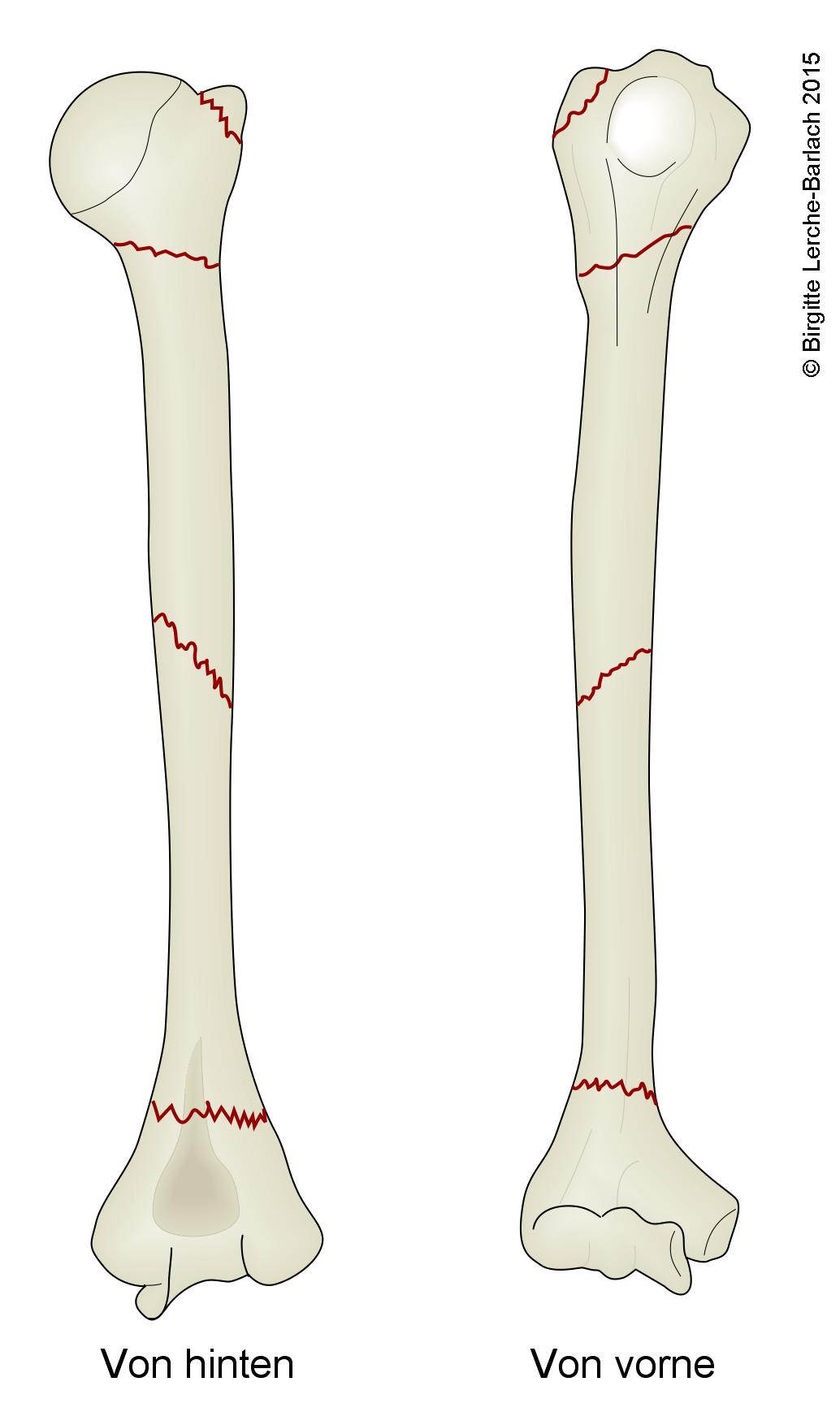 Humerus, haeufigste Brucharten.jpg