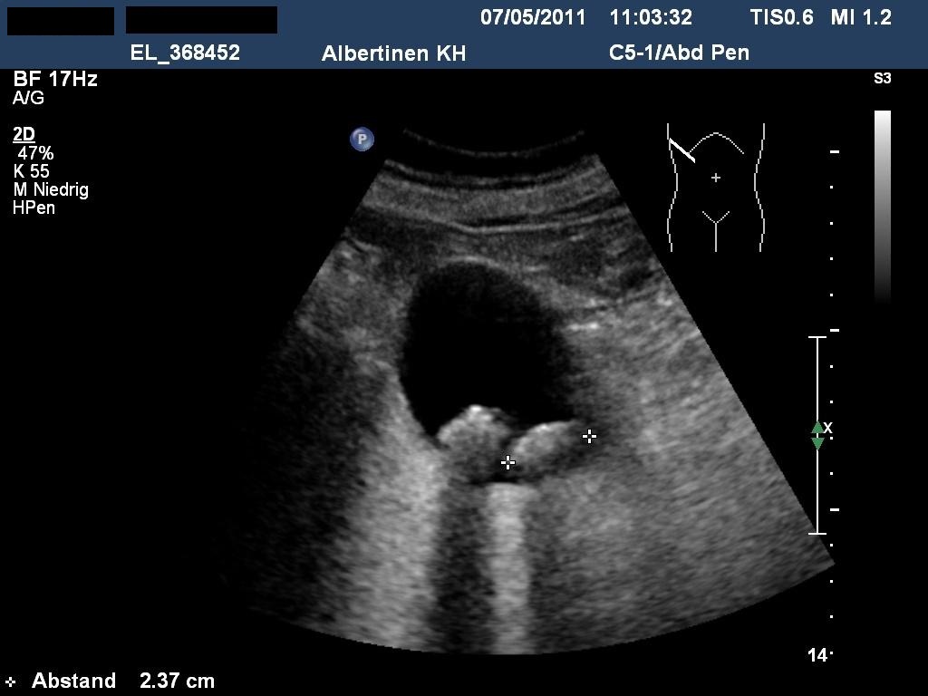 Sonografie: Cholezystolithiasis mit zwei größeren Gallenblasenkonkrementen in einer postprandial kontrahierten Gallenblase