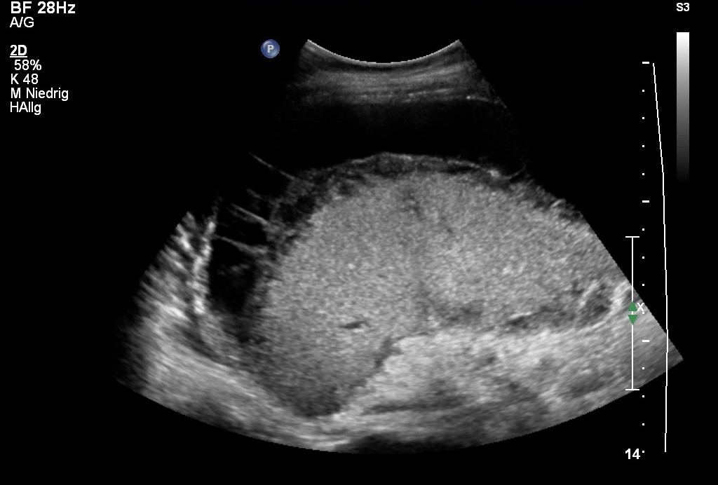Lazeration der Milz nach Motorradunfall in der Sonografie (Mit freundlicher Genehmigung von sonographiebilder.de ©Albertinen-Diakoniewerk e.V., Hamburg)