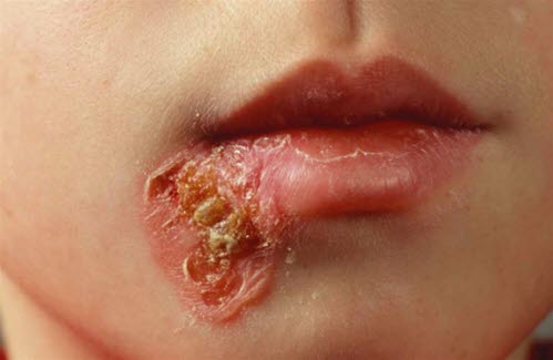 Brennkopper (impetigo) ved leppe