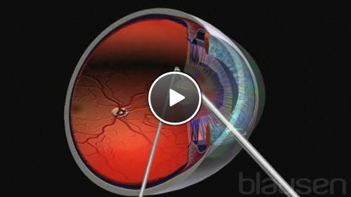 linseimplantat