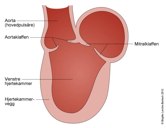 V.ventrikkel - cardiomyopathi ved diabetes