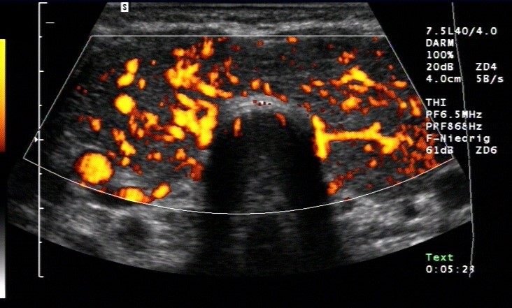 Duplexsonografie: Morbus Basedow mit Hypervaskularisation