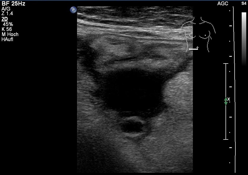 Sonografie: Akute Appendizitis mit Aszites (mit freundlicher Genehmigung von sonographiebilder.de ©Albertinen-Diakoniewerk e. V., Hamburg).