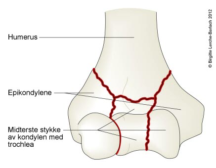 7326-2-fraktur-transkondyler-komminut-humerus.jpg