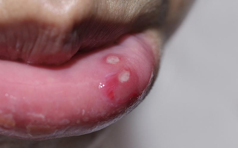 Ich herpes pickel hab Lippenherpes: Auslöser,