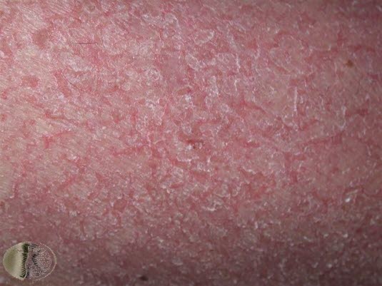 Fotoet viser eksema craquelé (asteatotisk dermatitt - svært tørr hud)