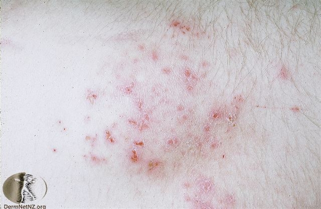 Dermatitis herpetiformis Dermatitis herpetiformis
