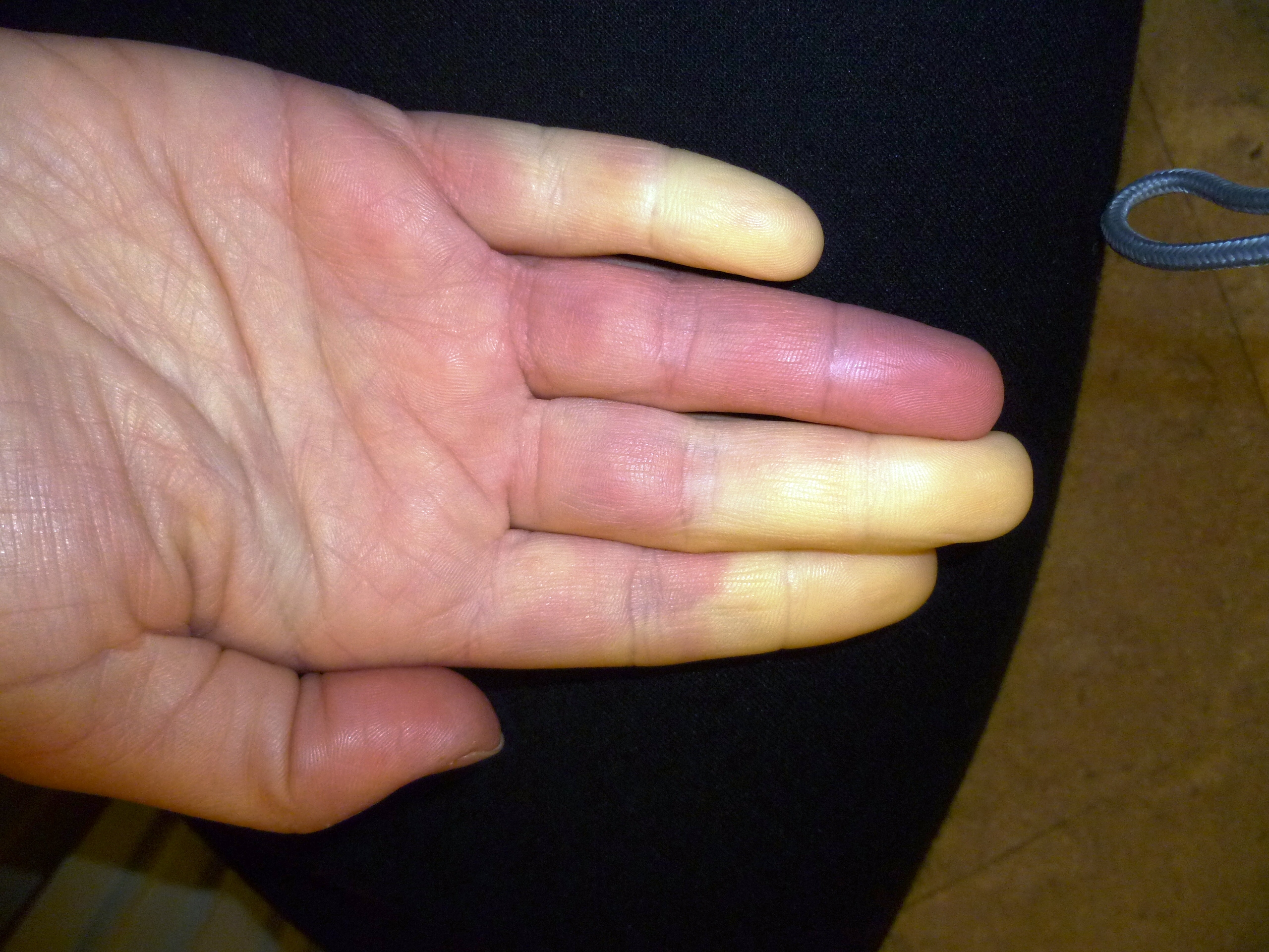 Raynaud (3).JPG