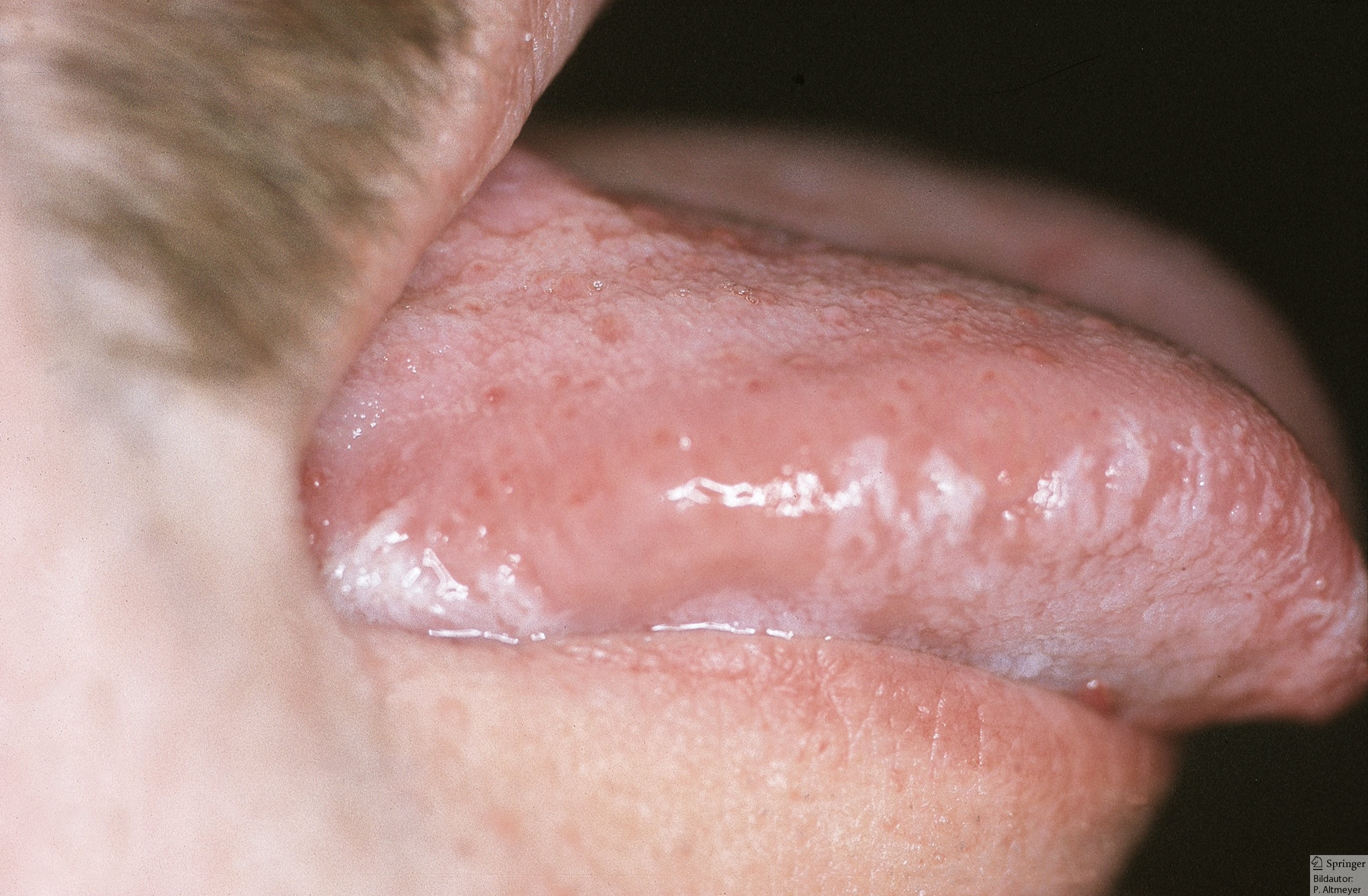 fruh haarige leukoplakie