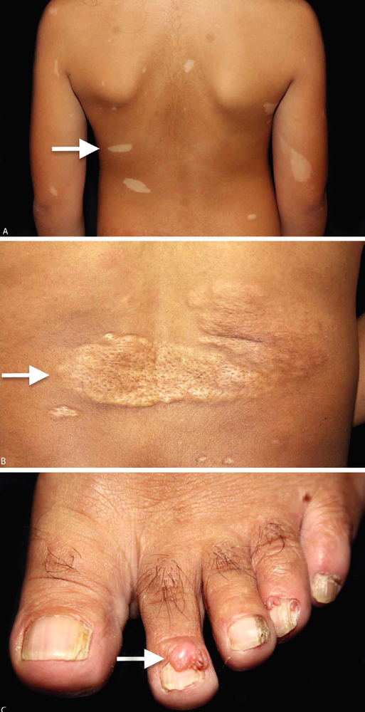 Bilder som viser hudforandringer ved tuberøs sklerose