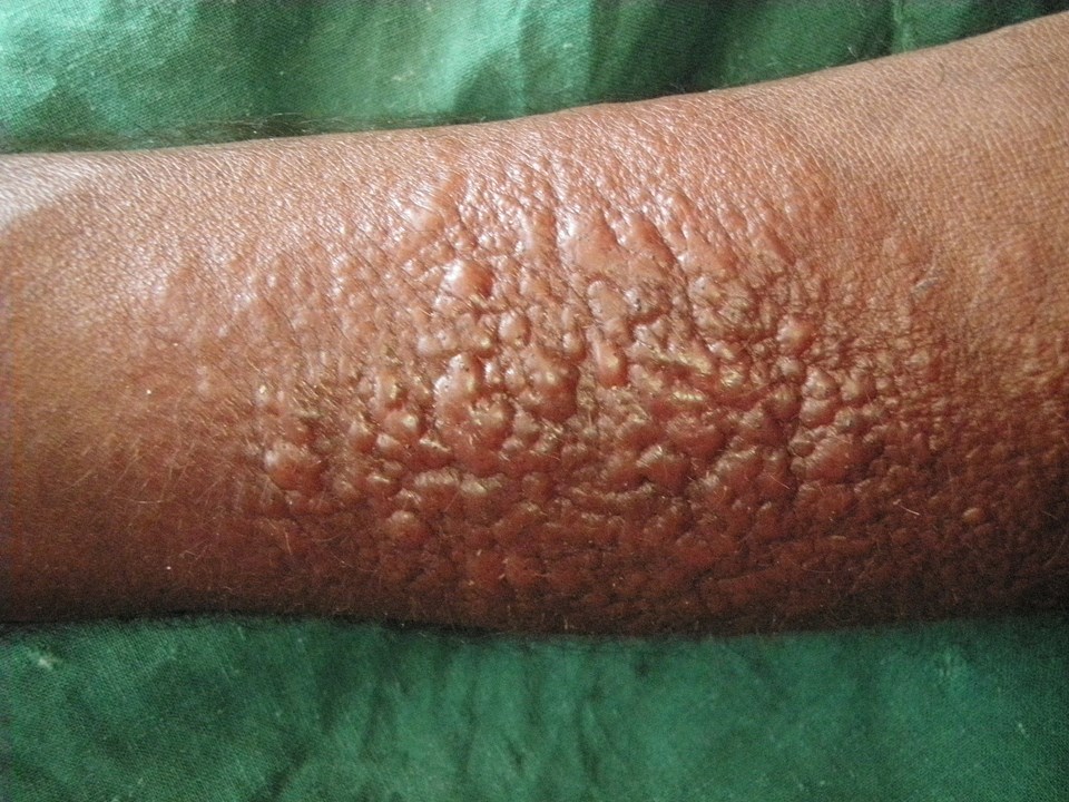 47367-2-leishmaniasis.jpg