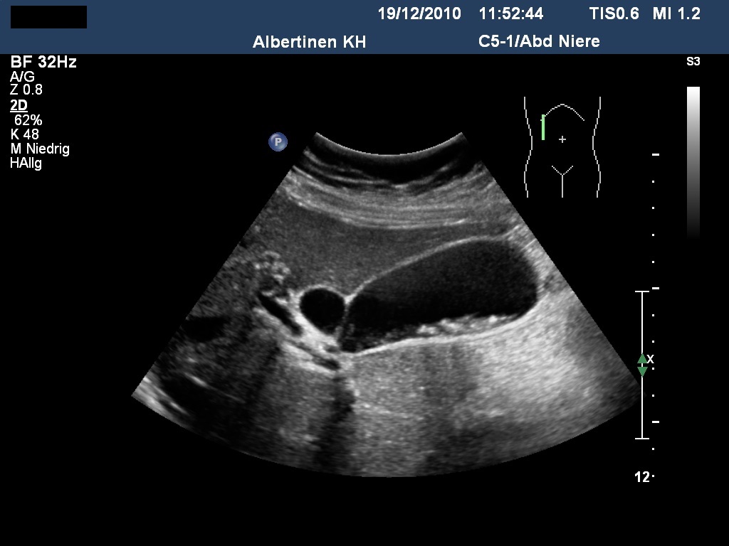 Sonografie: Cholezystolithiasis mit kleinen Gallenblasenkonkrementen in unauffälliger Gallenblase