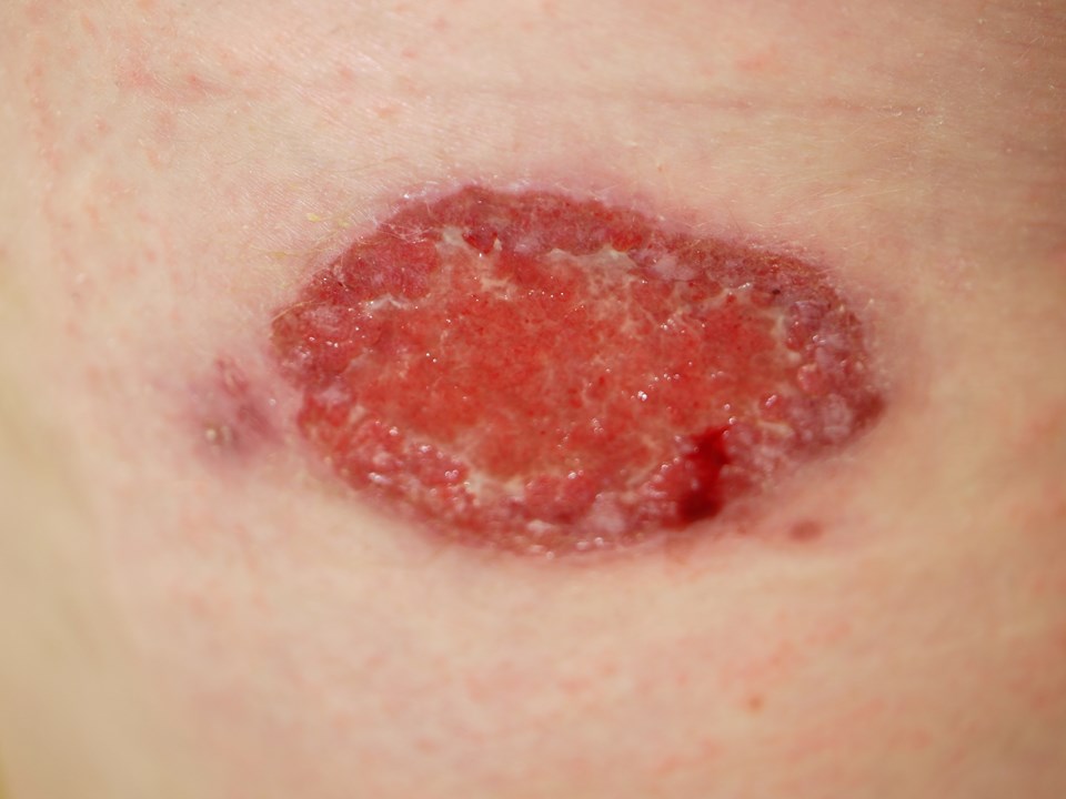 47369-2-leishmaniasis.jpg