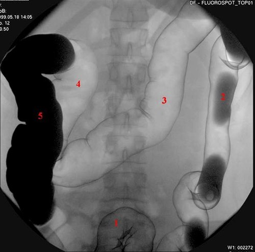 383-2-colon-dobbelkontrast.jpg