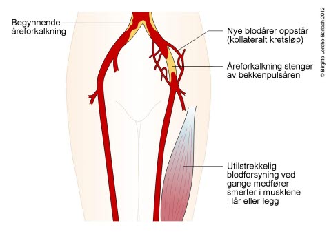 5851_10082-2-areforkalkning-i-benene-claudicatio.jpg