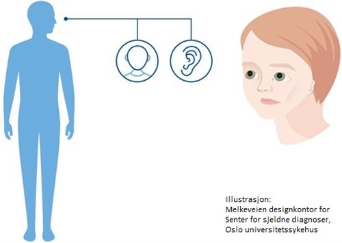 Craniofacial mikrosomi (OAVS).jpg