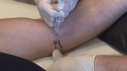 Insticksställe vid medial epikondylalgi Insticksställe vid medial epikondylalgi