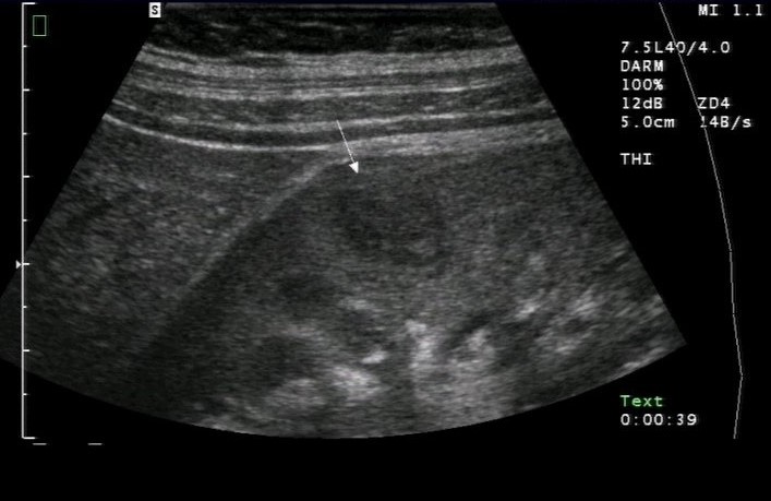 Sonografie: Akute Pyelonephritis mit Inhomogenität im Nierenparenchym infolge Abszessbildung; Pfeil: Abszess (mit freundlicher Genehmigung von sonographiebilder.de ©Albertinen-Diakoniewerk e. V., Hamburg).