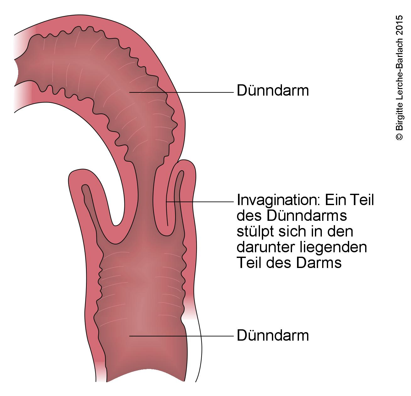 Invagination des Dünndarms