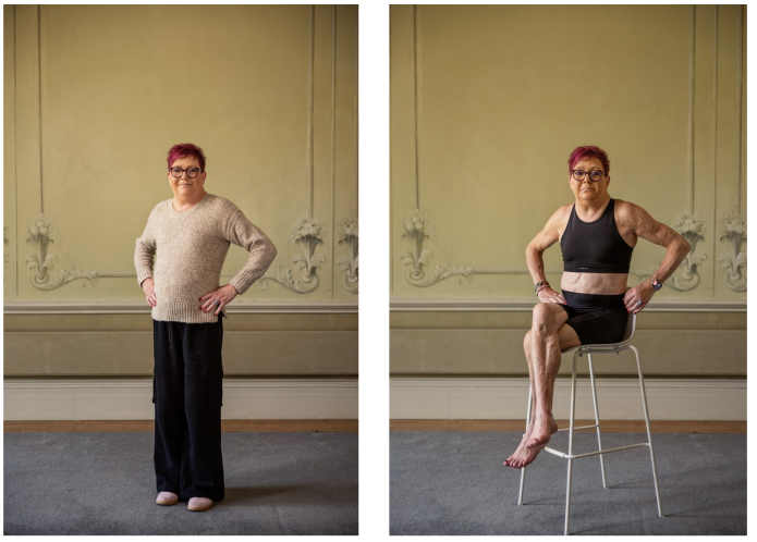 illustrasjonsfotoet viser bilder av dame med partiell lipodystrofi