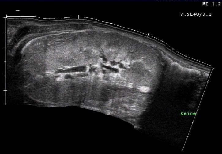 Sonografie: Pyelonephritis mit Inhomogenität im Nierenparenchym (mit freundlicher Genehmigung von sonographiebilder.de ©Albertinen-Diakoniewerk e. V., Hamburg).