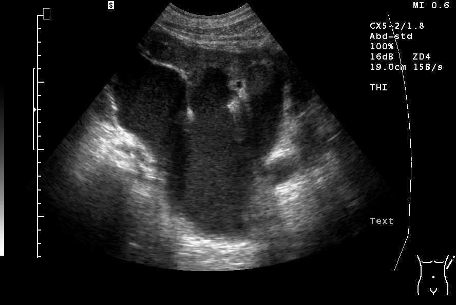 Hydronephrose Grad IV („Wassersackniere") Nierenbecken und Kelche maximal erweitert und nicht voneinander zu trennen bei Unterbauchtumor mit Ummauerung des Ureters (mit freundlicher Genehmigung von sonographiebilder.de ©Albertinen-Diakoniewerk e. V.).