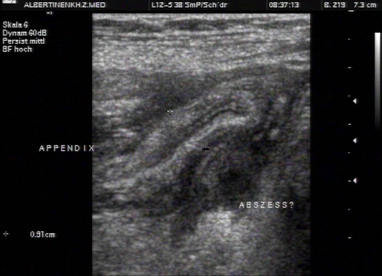 Sonografie: Akute Appendizitis mit Pannusbildung und Abszess (mit freundlicher Genehmigung von sonographiebilder.de ©Albertinen-Diakoniewerk e. V., Hamburg).