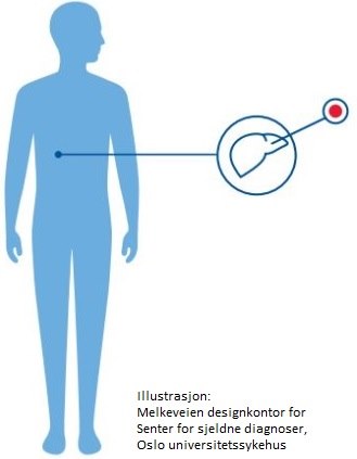 Maple Syrup Urine Disease