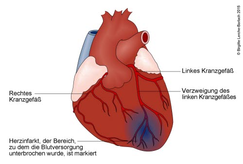 Herzinfarkt durch Verschluss des linken Herzkranzgefäßes