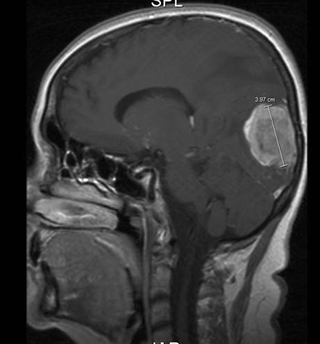 Hirnmetastase bei Brustkrebs, sagittaler Schnitt