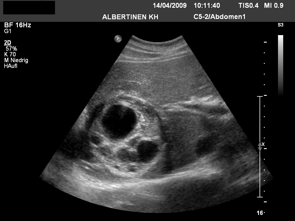 Sonografie: Echinokokkose (Echinococcus granulosus) (mit freundlicher Genehmigung von sonographiebilder.de ©Albertinen-Diakoniewerk e. V., Hamburg)on sonographiebilder.de ©Albertinen-Diakoniewerk e.V., Hamburg