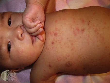 4202-2-skabb-baby.jpg 4202-2-skabb-baby.jpg
