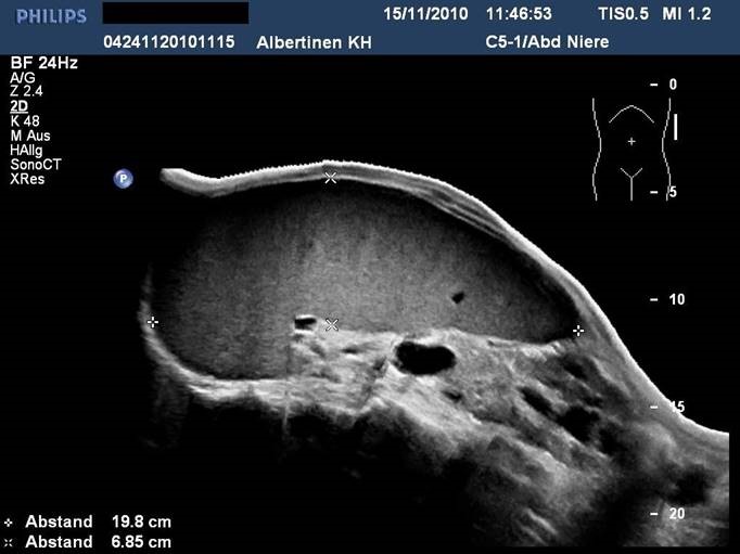 Splenomegalie bei CML.jpg