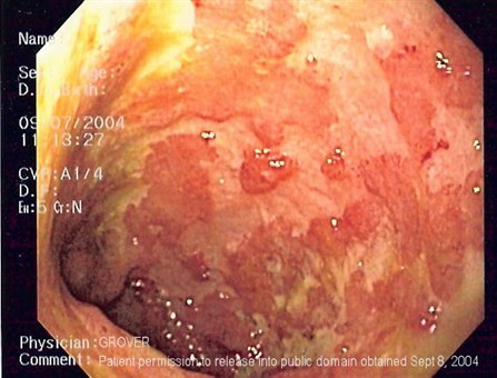 Ulcerative colitis.jpg Ulcerative colitis.jpg