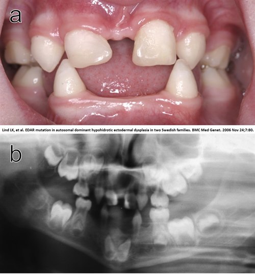 Ectodermal dysplasi (HED)