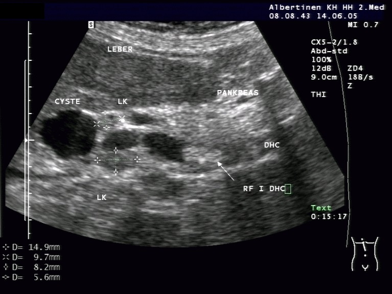 Sonographie: Extrahepatisches cholangiozelluläres Karzinom (Mit freundlicher Genehmigung von sonographiebilder.de ©Albertinen-Diakoniewerk e.V., Hamburg)
