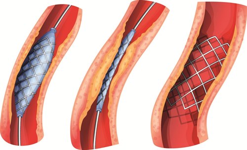 Angioplastikk med stenting
