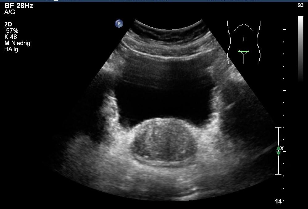 Sonografie: Prostatahyperplasie (mit freundlicher Genehmigung von sonographiebilder.de ©Albertinen-Diakoniewerk e. V., Hamburg).