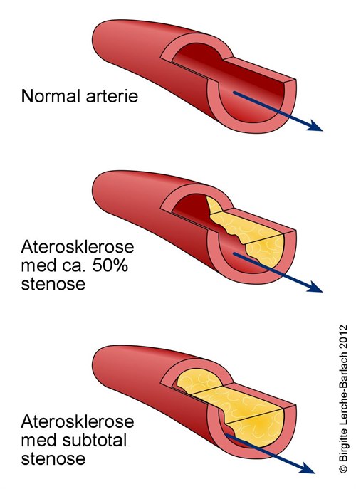 Aterosklerose Aterosklerose