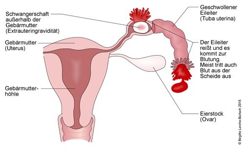 Extrauteringravidität