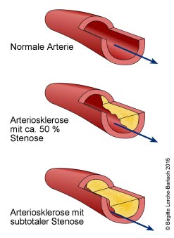 Arteriosklerose mit Einengung (Stenose) des Blutgefäßes